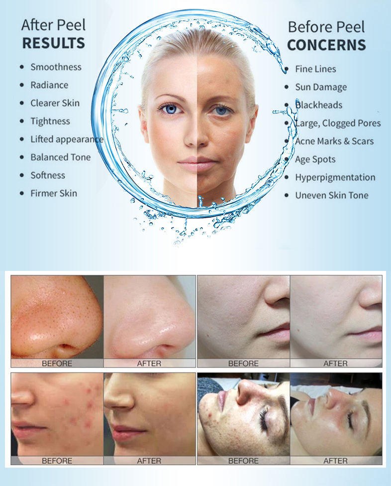 Hydra 4 In 1 Aqua Peeling Skin - đánh giá và giá Hydra Dermabrasion Aqua Peel Machine