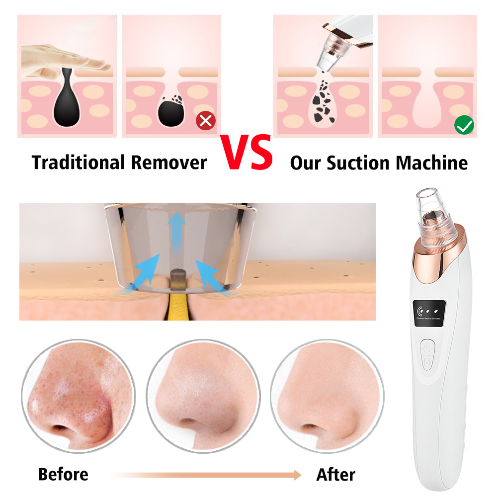 Mụn Đầu Đen Vacosi Pore Cleane - đánh giá và giá Blackhead Remover Vacuum Suction