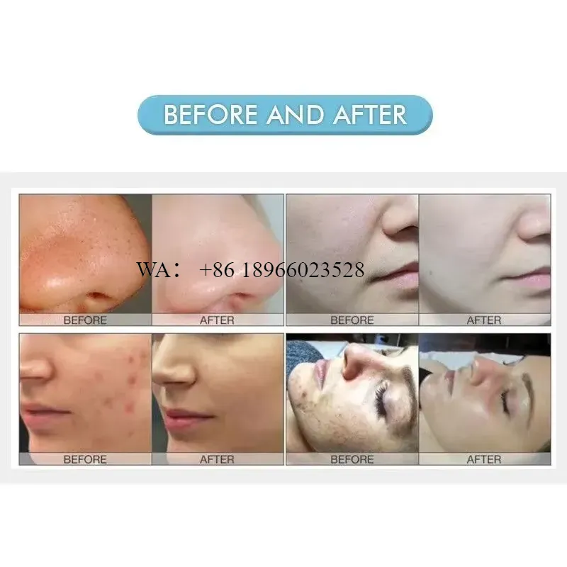 WMWMNU for Desktop Blackhead R - đánh giá và giá Blackhead Remover Vacuum Suction
